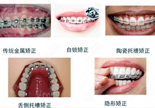 牙齿矫正的各种类型图对比