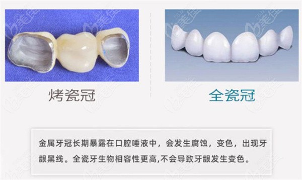 烤瓷牙冠和全瓷牙冠优缺点对比