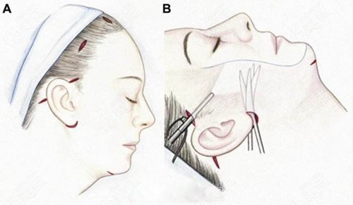 哈尔滨双燕整形拉皮手术对比图