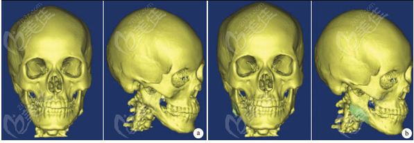 3d打印下颌角修复人工骨前后对比图
