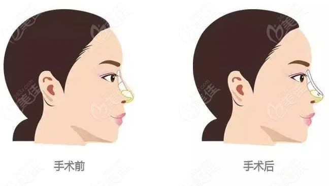福州林峰做鼻子实例