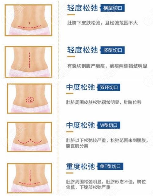 腹壁整形手术切口类型