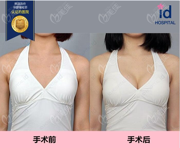 韩国ID整形外科是韩国本土姐妹爱去的隆胸医院