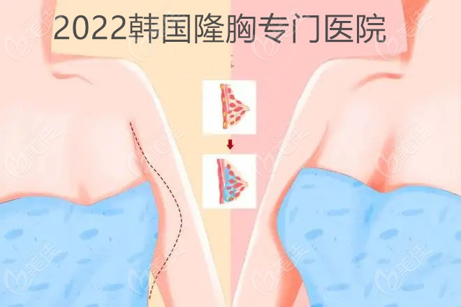 2022韩国隆胸专门医院