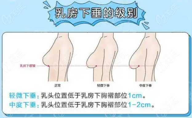 南京康美的罗盛康医生乳房下垂矫正类型