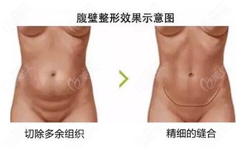 www.236z.com提供的腹壁成型切口图