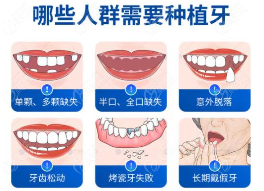 南昌鼎植口腔做种植牙的类型