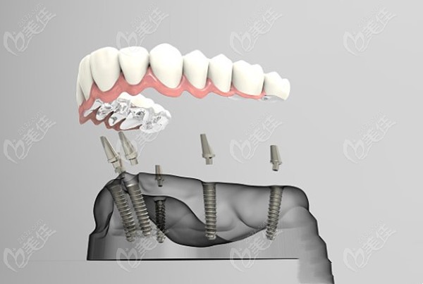 黎万洲医生开展的种植牙技术