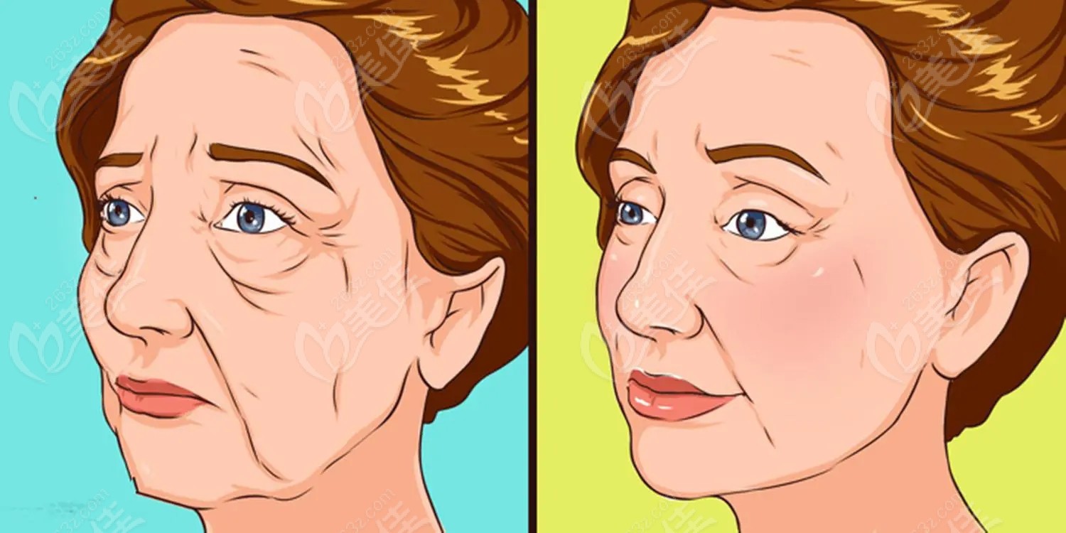 哈爾濱瑞麗拉皮手術(shù)實(shí)例