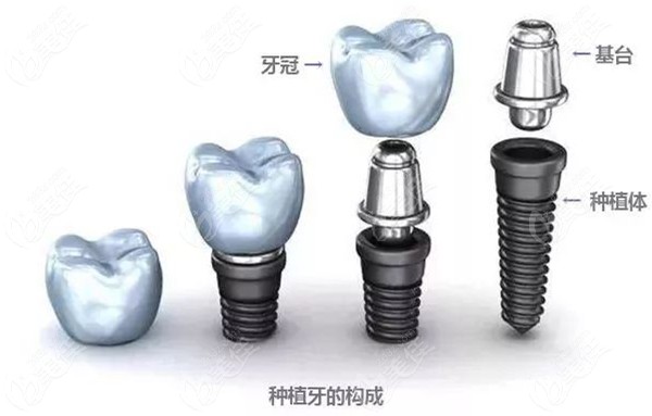 绍兴柯桥区、上虞区、越城区的种植牙价格相差不大