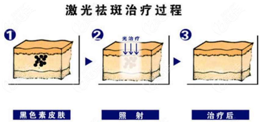 激光祛斑治疗过程