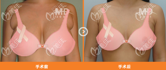 韩国MD整形外<!--<i data=20240703-sp></i>-->胸修复前后对比