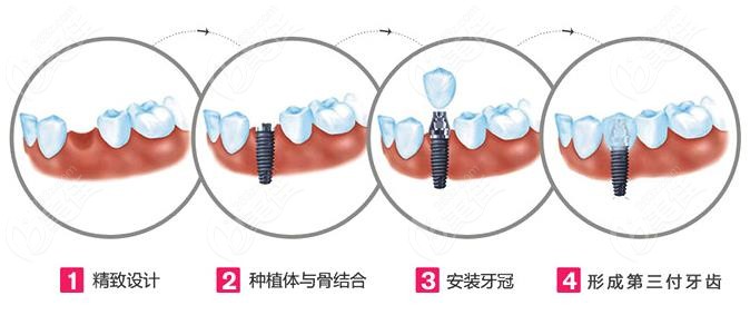 玉溪舒尔口腔种植牙流程