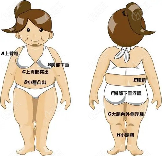 郑州哪家医院抽脂技术好