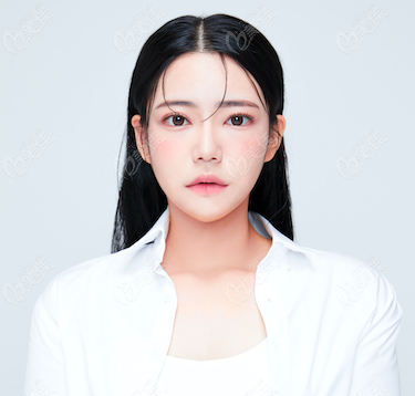 韩国雅阁眼部+鼻部+轮廓三件套整形术后三个月