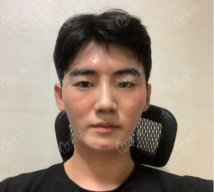 韩国雅阁ARC整形男士肋骨隆鼻术后第七天