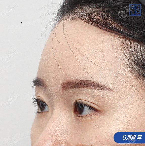 韓國(guó)MIDLINE額頭提升術(shù)后6個(gè)月45度照片