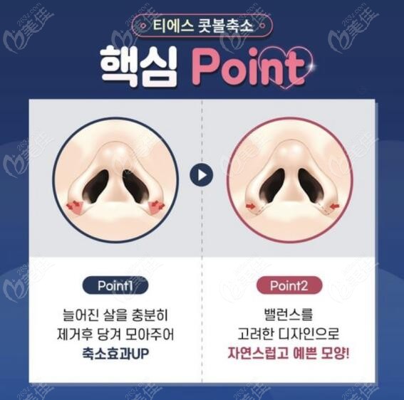 韩国TS做鼻翼缩小手术技术优势