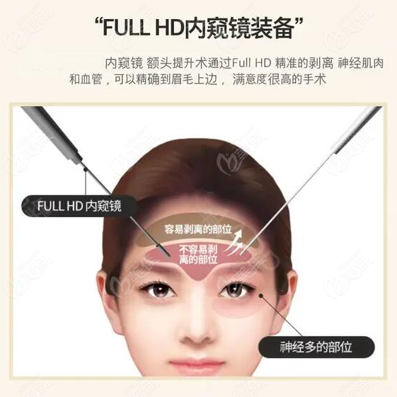 Full HD內(nèi)窺鏡額頭提升技術(shù)優(yōu)勢(shì)