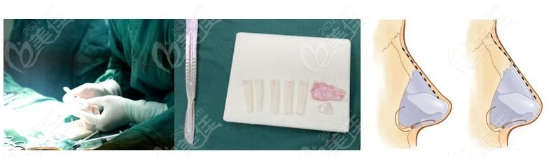 <!--<i data=20240703-sp></i>-->在隆鼻的过程中采用美鼻骨性雕刻技术