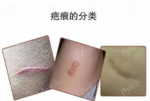 上海清沁陈明华医生科普疤痕类型有哪些