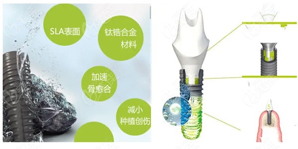 <!--<i data=20240703-sp></i>-->口腔全口种植牙好