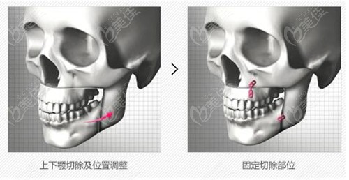 www.236z.com提供的凸嘴正颌手术过程