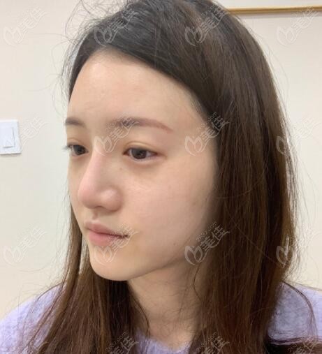 韩国koko鼻部整形外科医院做异体肋骨鼻综合前的照片图