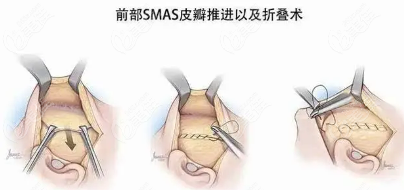 国内smas筋膜提升手术