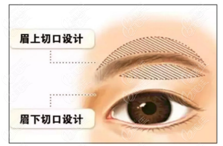 提眉术
