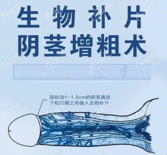 生物補片是什麼男性陰莖增大增粗用生物補片可以增粗多少釐米手術費用