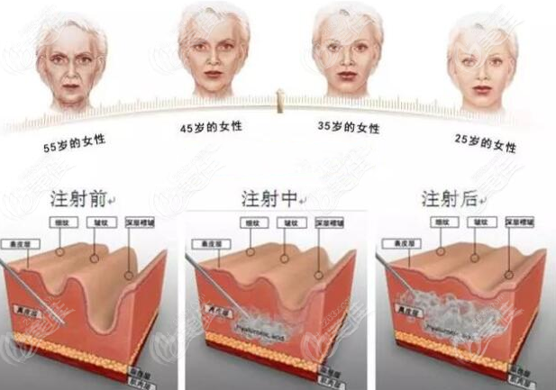 爱贝芙填充抗衰图示