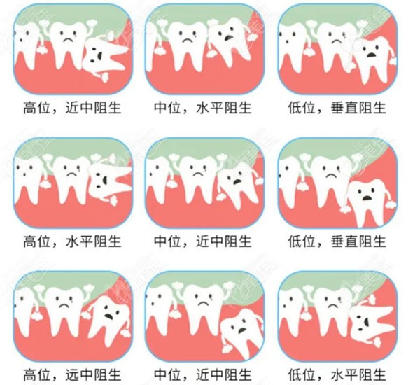 拔智齿多少钱一颗2022价格表