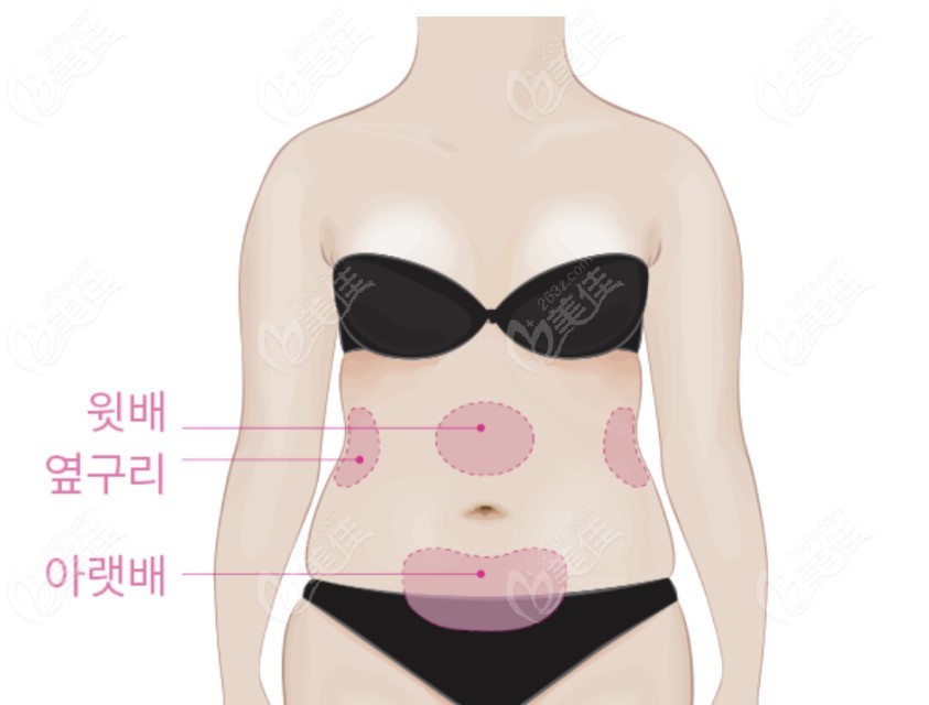 韩国id医院腰腹抽脂真实经历:术后三个月腰围瘦8厘米且留疤几率小