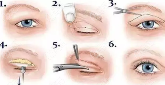 双眼皮手术