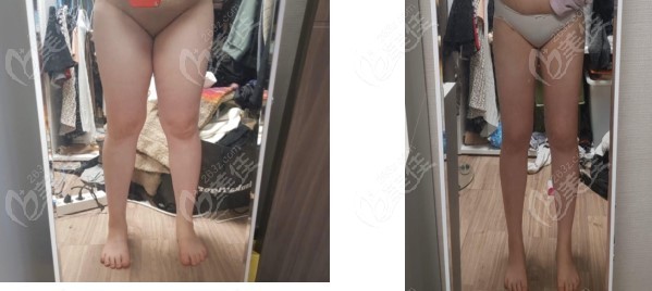 韩国Qline女性医院大腿吸脂前后对比照
