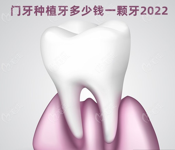 门牙种植牙多少钱一颗牙2022
