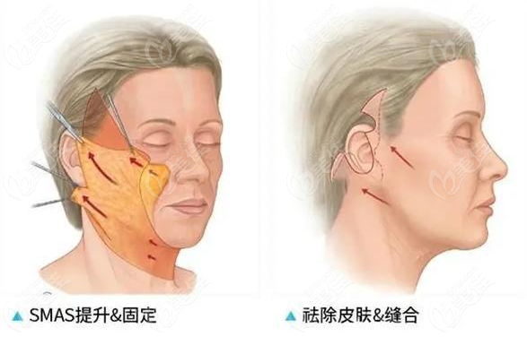 拉皮手术