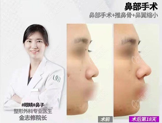 韩国原辰金志修鼻综合手术+鼻翼缩小术后对比图