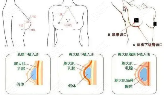 丰胸手术图解图片