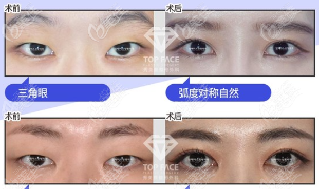 韩国秀美颜眼综合对比图