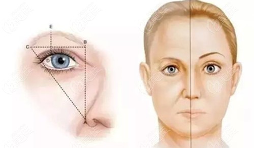 下眼瞼面部提升前后對(duì)比