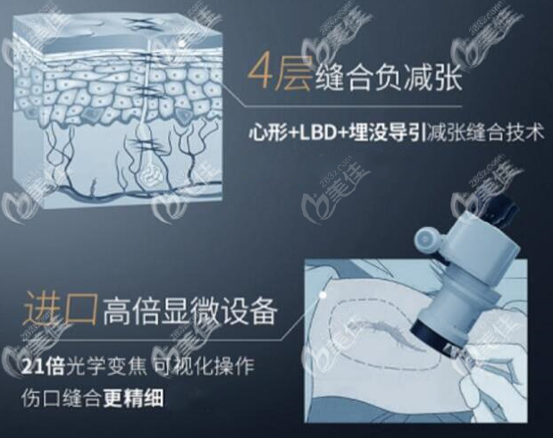 4层减张缝合技术