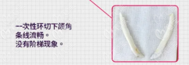 景氏风格长曲线下颌角磨骨