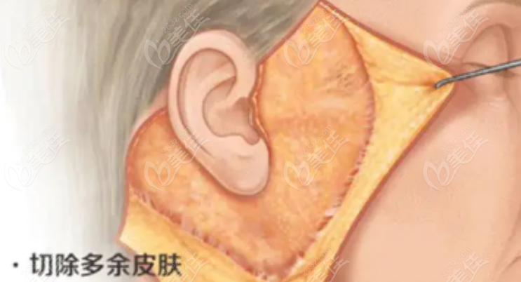 拉皮手术