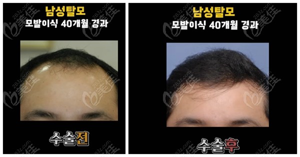 韩国头顶加密种植实例图