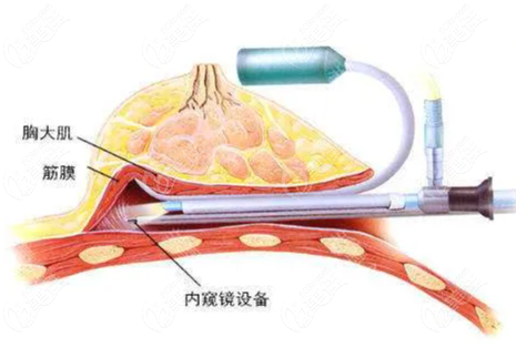 隆胸