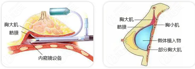 内窥镜隆胸手术