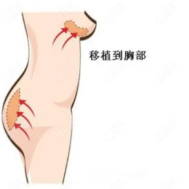 脂肪丰胸