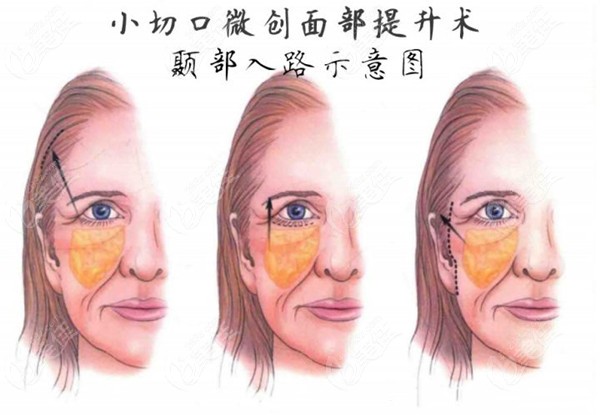 周龙医生擅长小切口拉皮手术